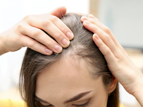 Haarausfall Behandlung Für Frauen