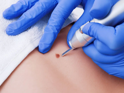 Mole Removal (Nevus Excision)