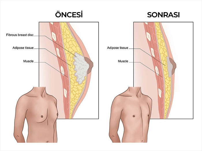 Jinekomasti Ameliyatı Öncesi Sonrası